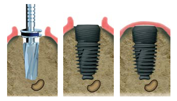 implant limoges