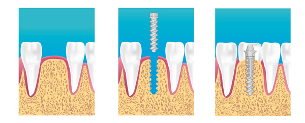 implant limoges